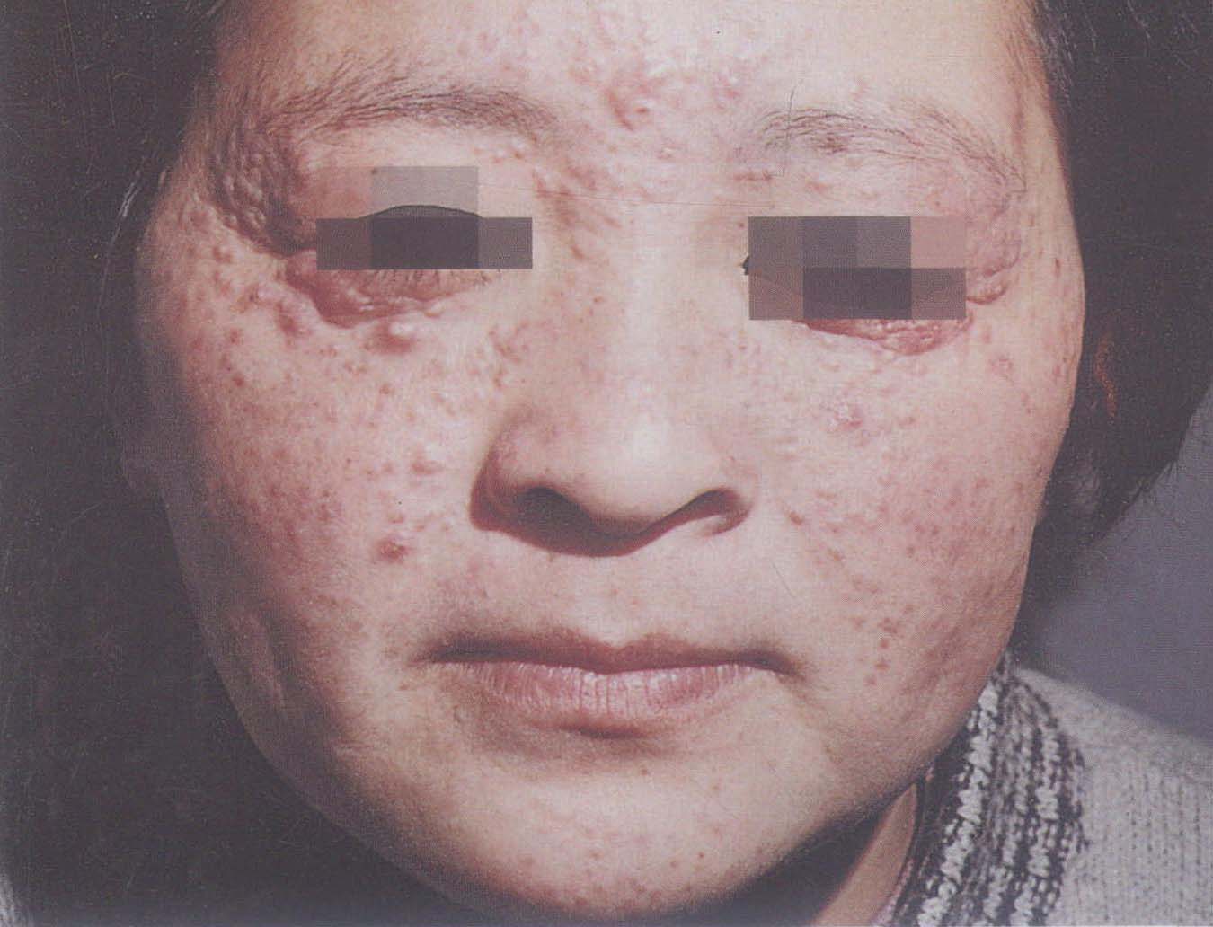 脸上红斑狼疮早期图片,脸上红斑是什么原因(4) - 伤感说说吧